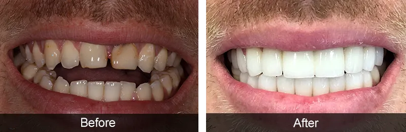 Original before and after photographs — Porcelain Veneers, case 43