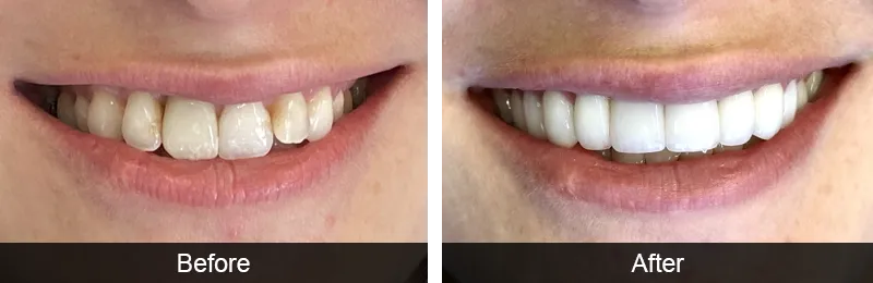 Original before and after photographs — Dental Implants, case 9