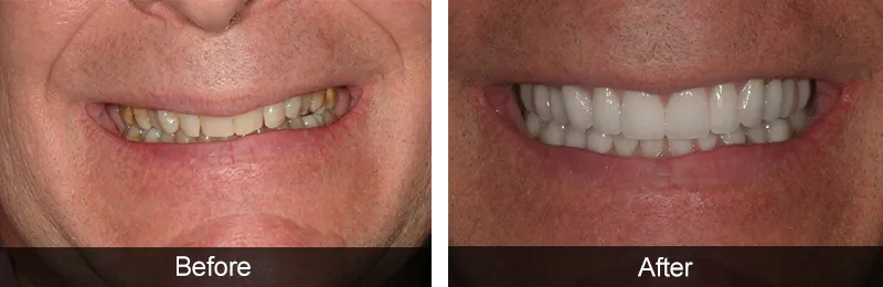 Original before and after photographs — Porcelain Veneers, case 53