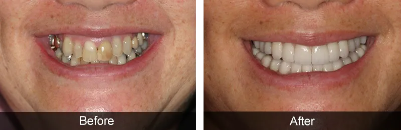Original before and after photographs — Porcelain Veneers, case 54