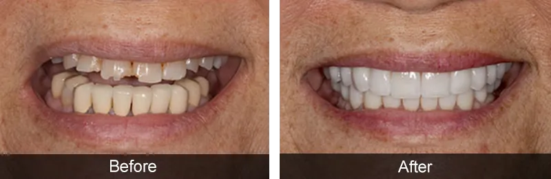 Original before and after photographs — Dental Implants, case 16