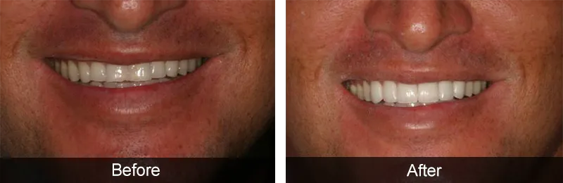 Original before and after photographs — Porcelain Veneers, case 69