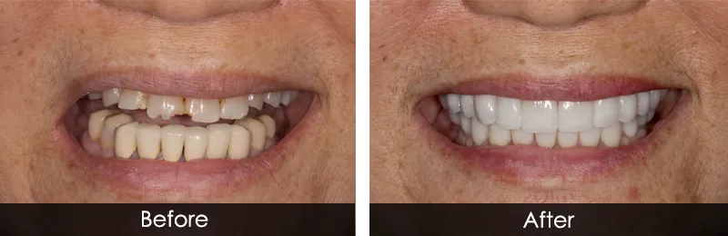 Original before and after photographs — Dental Implants, case 19