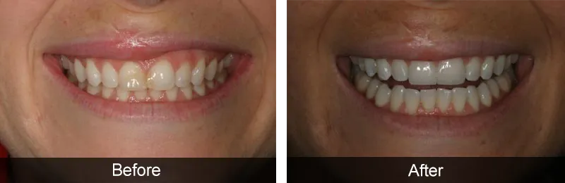 Original before and after photographs — Porcelain Veneers, case 66