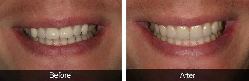Original before and after photographs — Porcelain Crowns, case 24