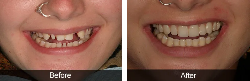 Original before and after photographs — Dental Implants, case 18