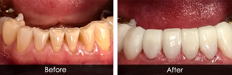 Original before and after photographs — Porcelain Veneers, case 71