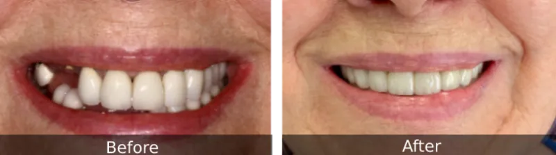 Original before and after photographs — Full Mouth Rehabilitation, case 93