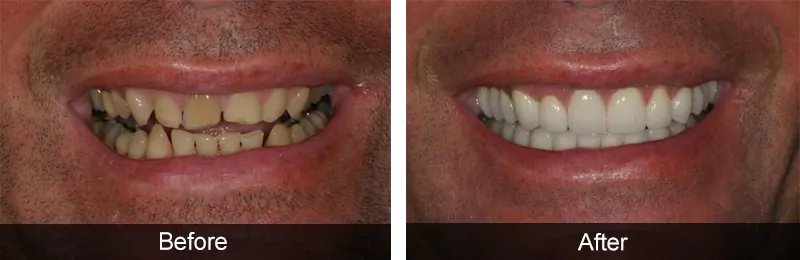 Original before and after photographs — Porcelain Veneers, case 70