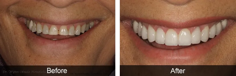 Original before and after photographs — Porcelain Veneers, case 62