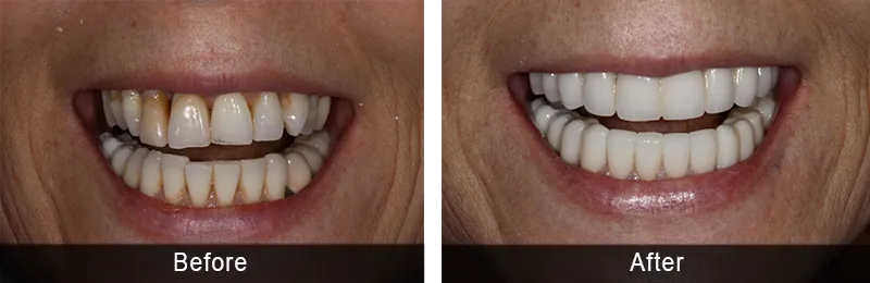Original before and after photographs — Full Mouth Rehabilitation, case 87