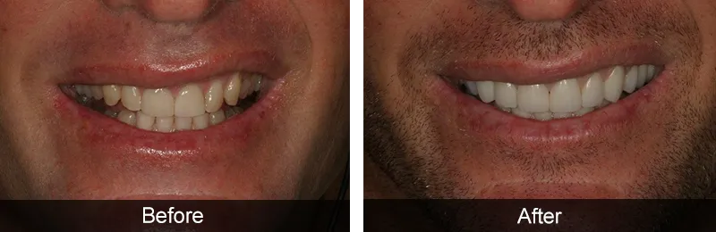 Original before and after photographs — Porcelain Veneers, case 59