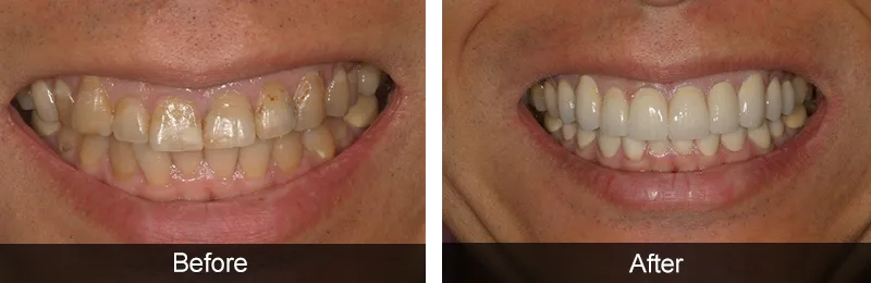 Original before and after photographs — Porcelain Veneers, case 51