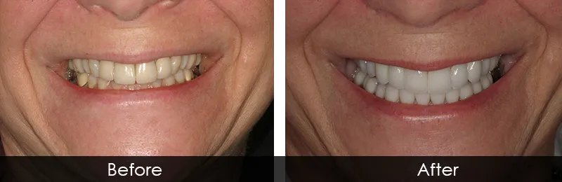 Original before and after photographs — Full Mouth Rehabilitation, case 79