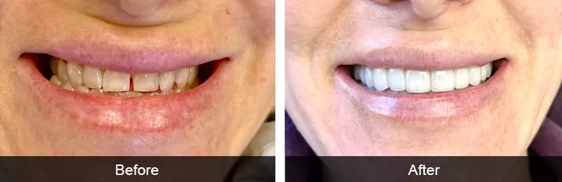 Original before and after photographs — Porcelain Veneers, case 75