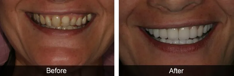 Original before and after photographs — Porcelain Veneers, case 63