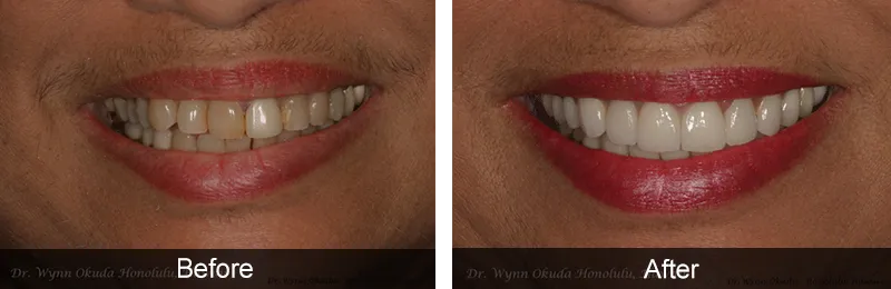 Original before and after photographs — Porcelain Veneers, case 45