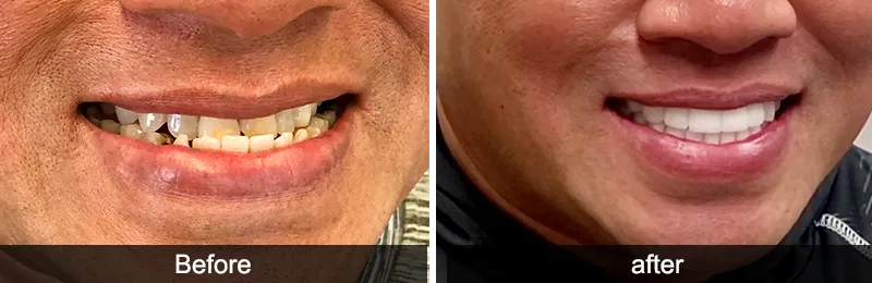 Original before and after photographs — Full Mouth Rehabilitation, case 80