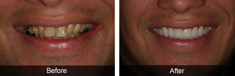 Original before and after photographs — Porcelain Veneers, case 49