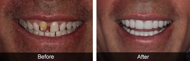 Original before and after photographs — Porcelain Veneers, case 60