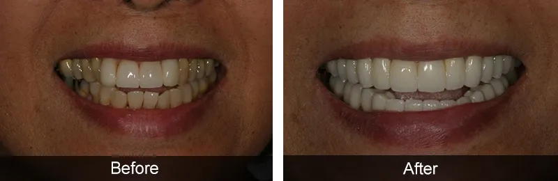 Original before and after photographs — Porcelain Crowns, case 31