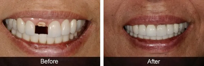 Original before and after photographs — Dental Implants, case 10