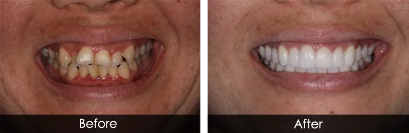 Original before and after photographs — Porcelain Veneers, case 73