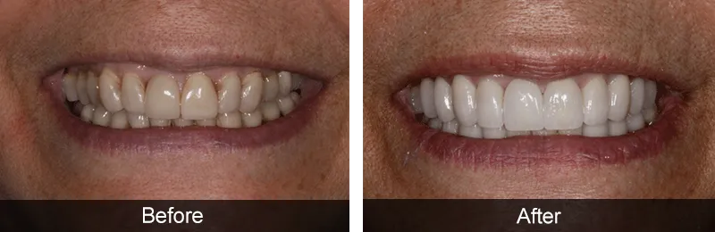 Original before and after photographs — Porcelain Veneers, case 61
