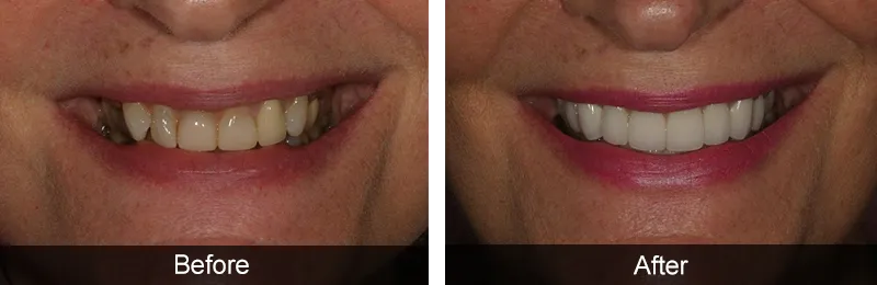 Original before and after photographs — Porcelain Veneers, case 55