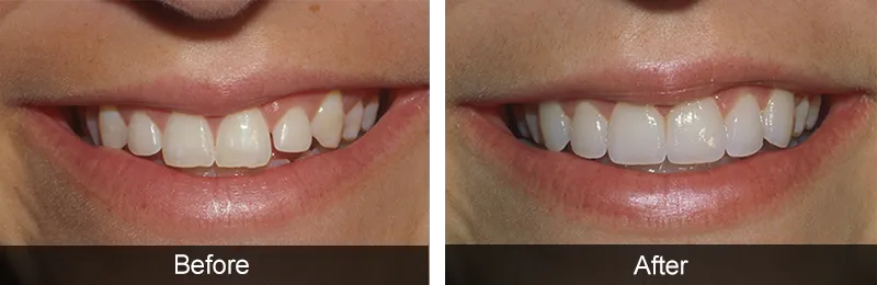 Original before and after photographs — Porcelain Veneers, case 42
