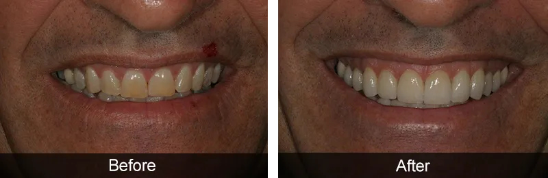 Original before and after photographs — Porcelain Veneers, case 50