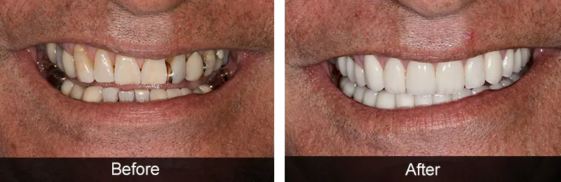Original before and after photographs — Full Mouth Rehabilitation, case 83