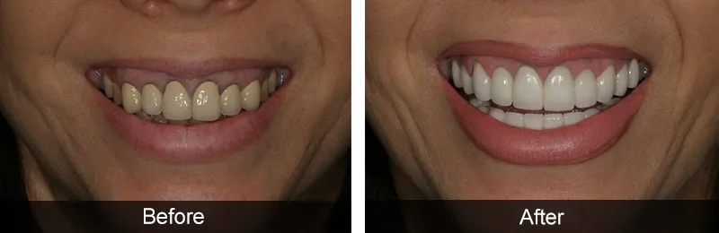 Original before and after photographs — Porcelain Crowns, case 26
