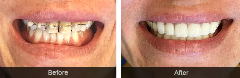 Original before and after photographs — Gum Sculpting, case 7