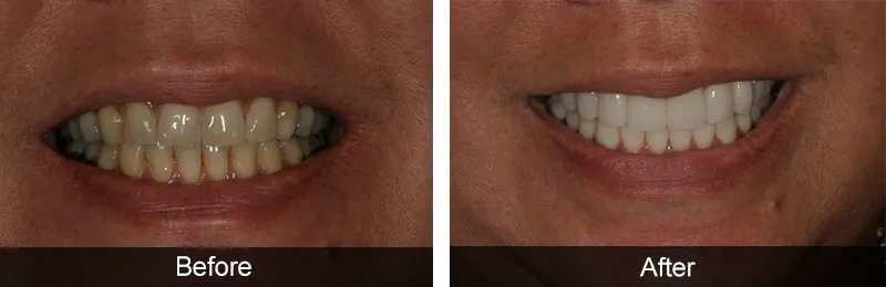 Original before and after photographs — Porcelain Veneers, case 58