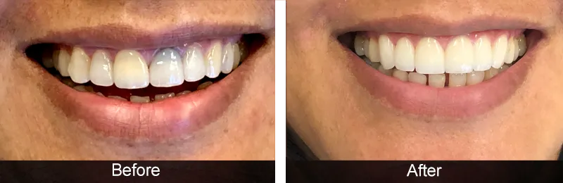 Original before and after photographs — Porcelain Veneers, case 38