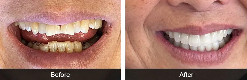 Original before and after photographs — Full Mouth Rehabilitation, case 94