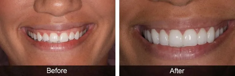 Original before and after photographs — Gum Sculpting, case 6