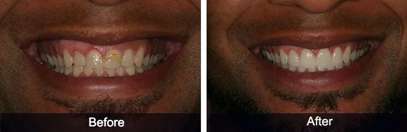 Original before and after photographs — Porcelain Veneers, case 36