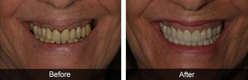 Original before and after photographs — Dental Implants, case 17