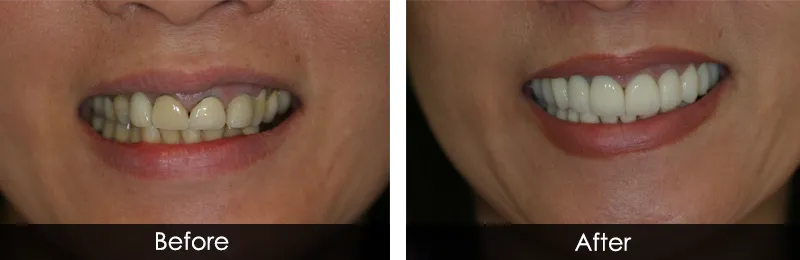 Original before and after photographs — Gum Sculpting, case 1