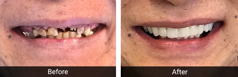 Original before and after photographs — Full Mouth Rehabilitation, case 82