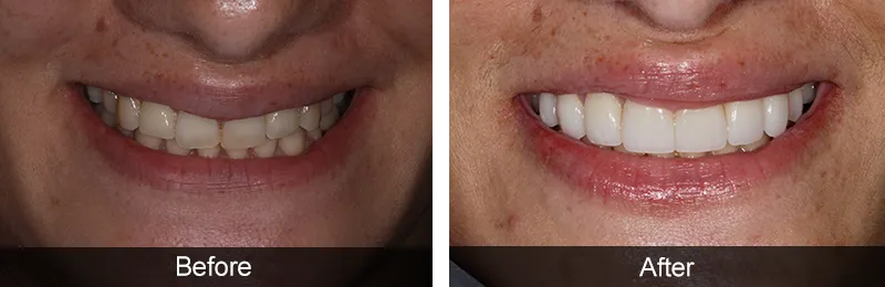 Original before and after photographs — Porcelain Veneers, case 41
