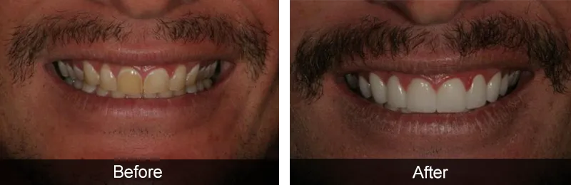 Original before and after photographs — Porcelain Veneers, case 67