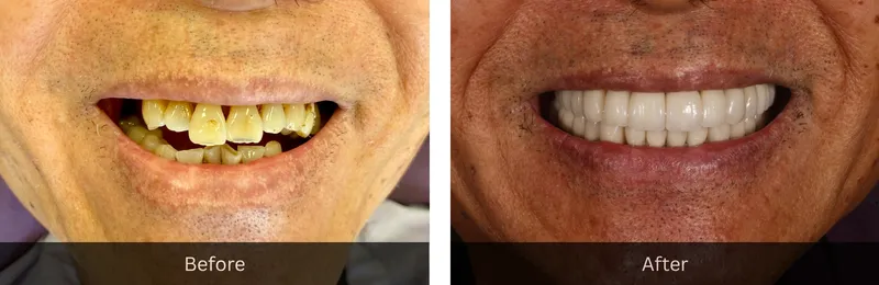 Original before and after photographs — Porcelain Veneers, case 32