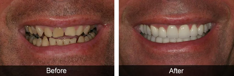 Original before and after photographs — Porcelain Veneers, case 57