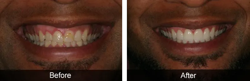 Original before and after photographs — Porcelain Veneers, case 65