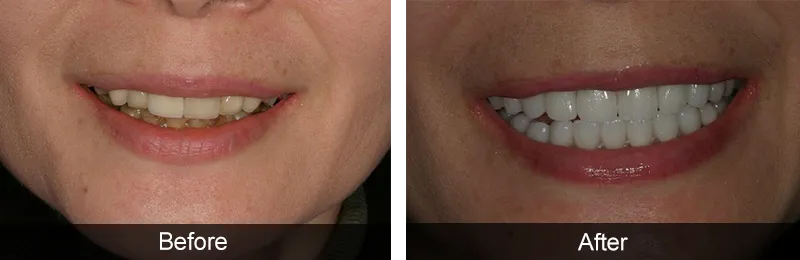 Original before and after photographs — Porcelain Crowns, case 27