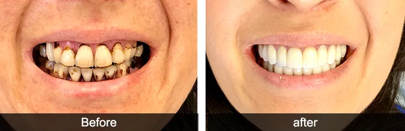 Original before and after photographs — Full Mouth Rehabilitation, case 81