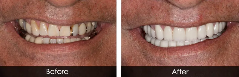 Original before and after photographs — Full Mouth Rehabilitation, case 89